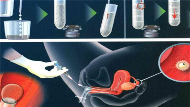 关于四个月药物流产引产过程的详细解析
