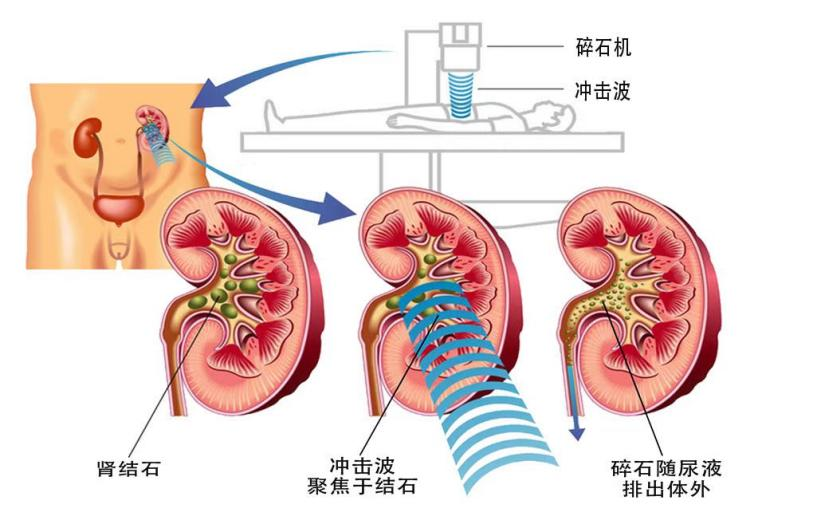 广东省医院治疗肾结石的专业方案与最新进展