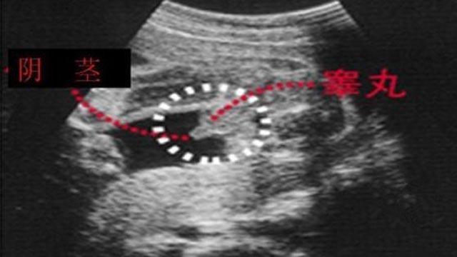 揭秘胎儿性别，关于B超查男女的真相