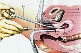 人流手术全过程，三个月的细致解读