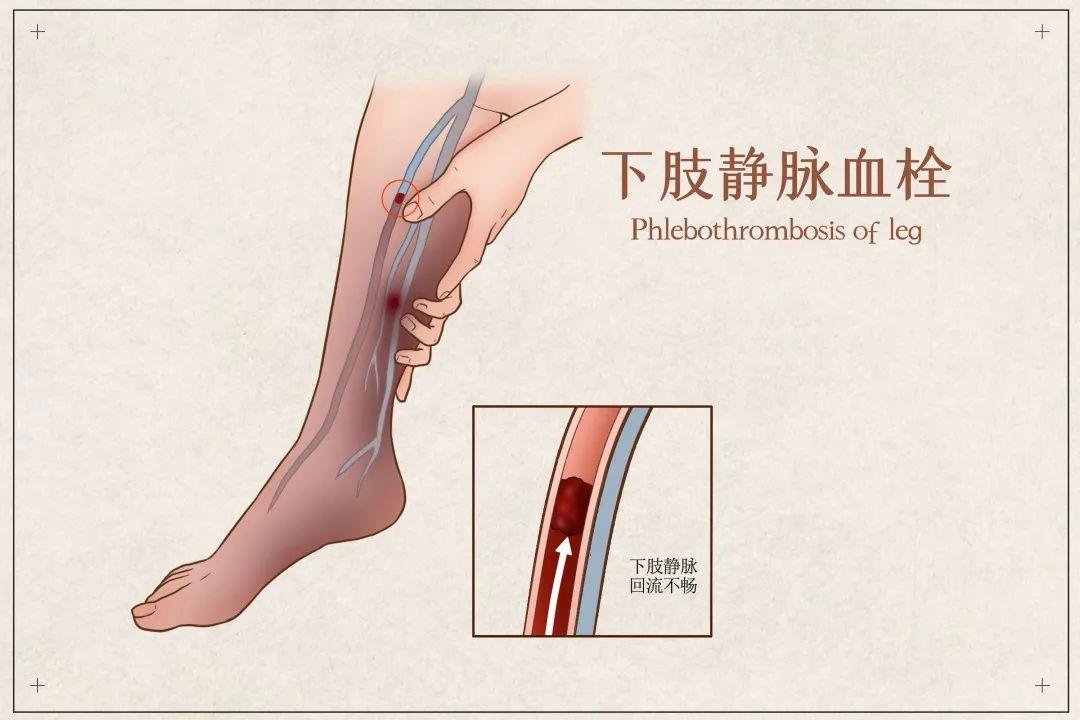 静脉血栓一个月，走路时腿部肿胀的挑战与应对策略