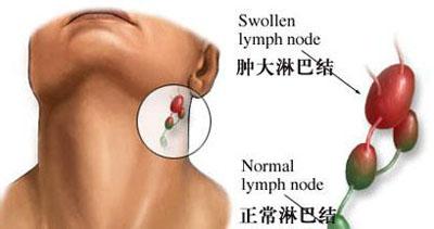 淋巴疼一个月，症状、原因及治疗方法